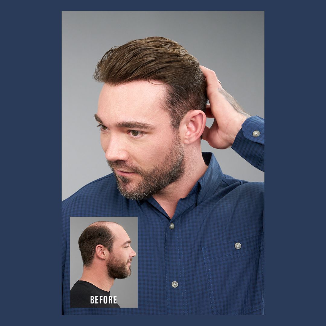 Men's Non-Surgical Hair Replacement In Yorba Linda